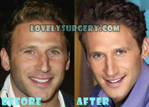 Mark Feuerstein Plastic Surgery Nose Job