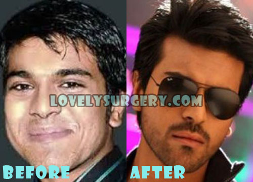 Image result for ramcharan before and after surgery