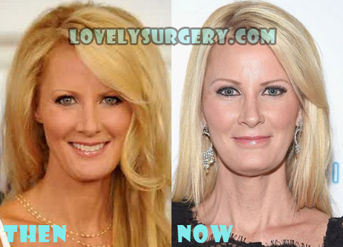 Sandra Lee Plastic Surgery Botox