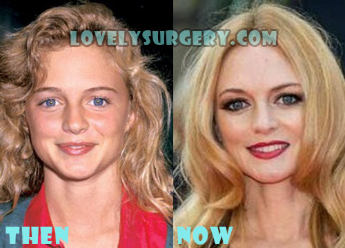 Heather Graham Plastic Surgery Botox