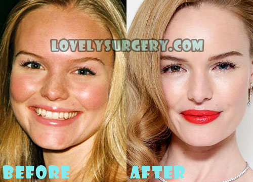 Kate Bosworth Plastic Surgery Nose Job