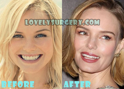 Kate Bosworth Plastic Surgery Rhinoplasty