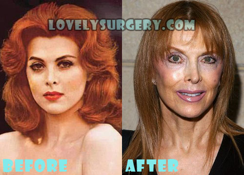 Tina Louise Plastic Surgery Facelift Gone Wrong