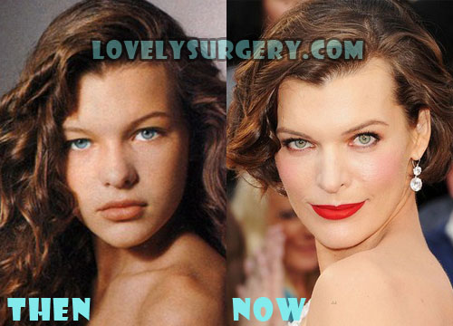 Milla Jovovich Plastic Surgery Botox