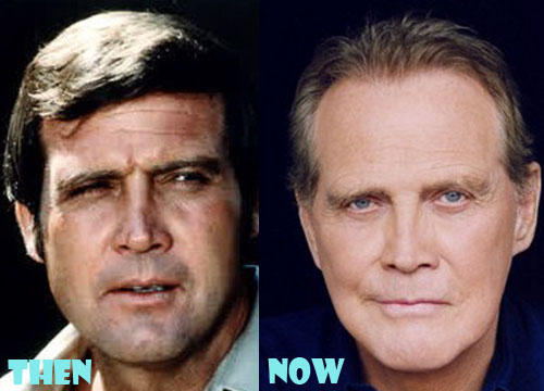 Lee Majors Plastic Surgery Before After Pictures - Lovely Surgery
