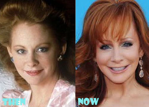 Reba McEntire Plastic Surgery Before After Pictures - Lovely Surgery