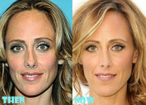 Kim Raver Plastic Surgery Before and After Photos