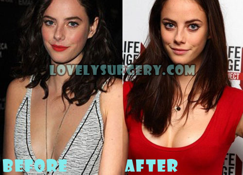 Kaya Scodelario Plastic Surgery Before and After Photos