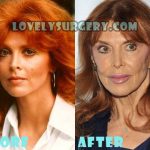 Mary Steenburgen Plastic Surgery Before and After